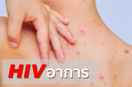 HIV อาการ