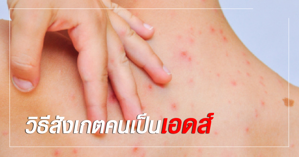 วิธีสังเกตคนเป็นเอดส์
