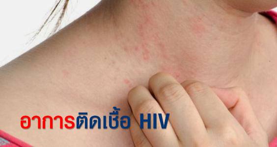 อาการติดเชื้อhiv