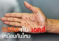ซิฟิลิส กับ เอดส์ เหมือนกันไหม