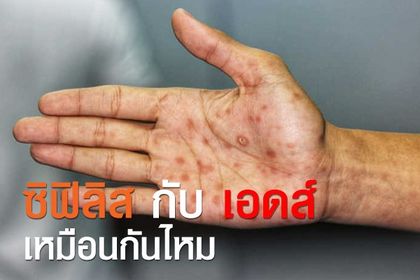 ซิฟิลิส กับ เอดส์ เหมือนกันไหม